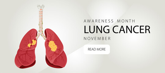 Banner informing about lung cancer. Design template for websites, magazines. Vector illustration cartoon style.