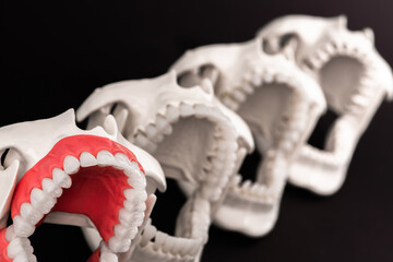 Dentist orthodontic teeth implants models with jaws opened on black background.