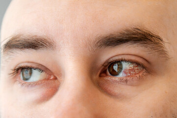 Fototapeta premium Close-up of male brown eyes with bruises, redness and burst vessels. The concept of irritation, inflammation and bacterial disease
