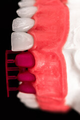 Teeth implant and crown installation process parts isolated on a blue background. Medically accurate 3D model. 