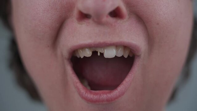 Broken central incisor tooth. Human teeth and dentures concept. Female with facial injuries after violence. Abuse and agression. Tooth broken half off. Beaten woman victim of domestic outrage.