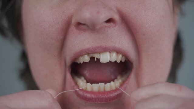 Dental floss important attribute of cleaning and hygiene oral cavity every day. Woman with bad teeth trying correct situation by flossing. Female with broken tooth. Damaged tooth cause poor hygiene.