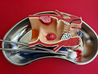 Proctologist operation anatomical model of rectum with hemorrhoids and surgical medical instrument