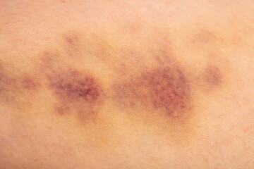 Bruises on the human body. Severe bruise from impact, bruising and hematoma. - obrazy, fototapety, plakaty