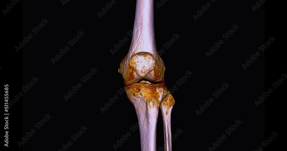 Poster ct scan of knee joint 3d rendering image turn around on the screen for diagnosis fracture tibia ,fib
