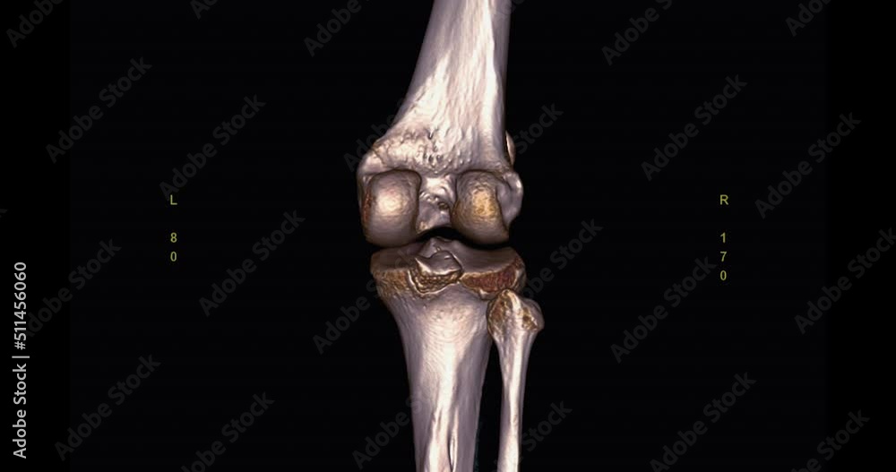 Poster ct scan of knee joint 3d rendering image turn around on the screen for diagnosis fracture tibia ,fib