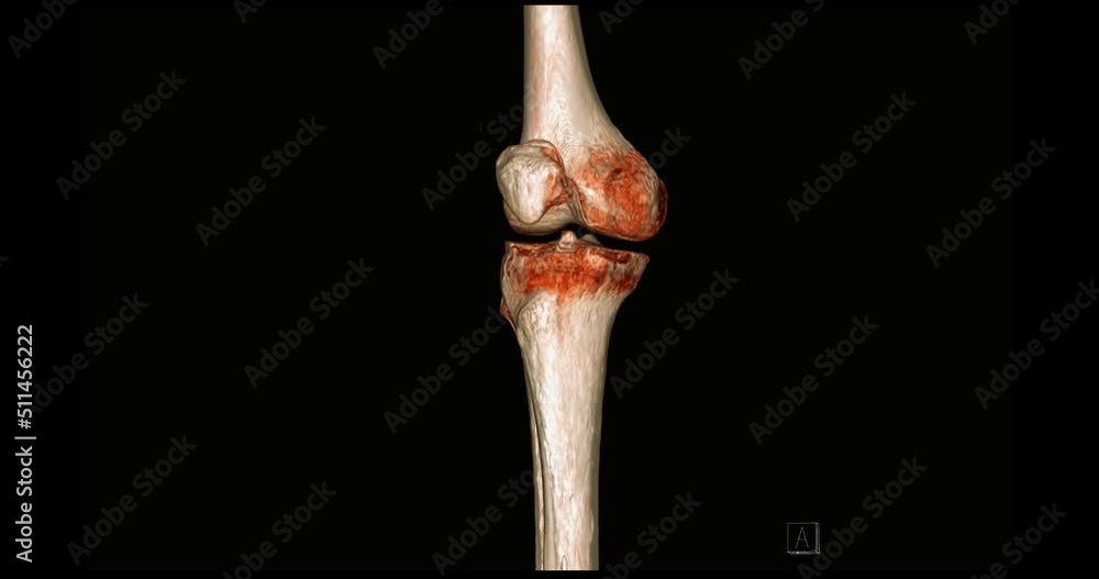 Poster ct scan of knee joint 3d rendering image turn around on the screen for diagnosis fracture tibia ,fib