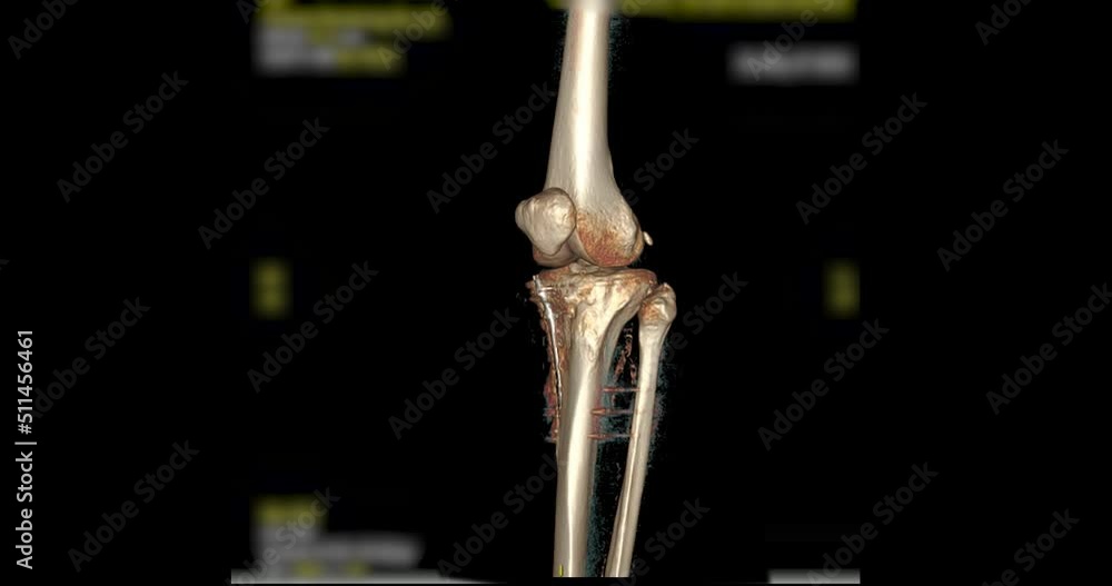 Poster ct scan of knee joint with fixation metal on the bone 3d rendering image turn around on the screen f