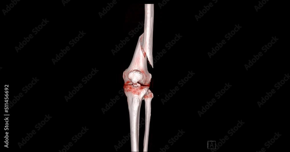 Poster ct scan of knee joint 3d rendering image turn around on the screen showing fracture femur bone.