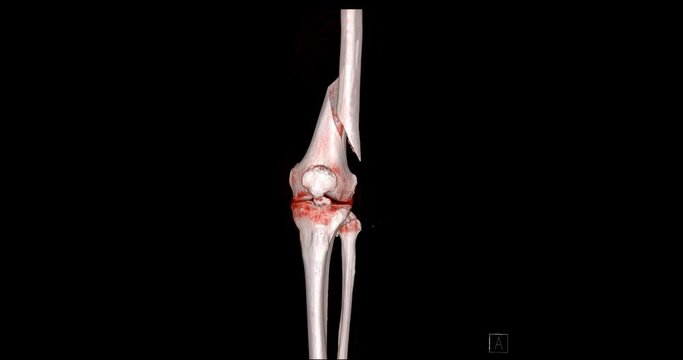 CT Scan of knee joint  3d rendering image  turn around on the screen showing   fracture femur bone.