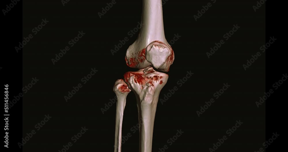 Poster ct scan of knee joint 3d rendering image turn around on the screen for diagnosis fracture tibia ,fib