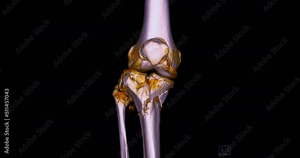 Poster ct scan of knee joint 3d rendering image turn around on the screen for diagnosis fracture tibia ,fib