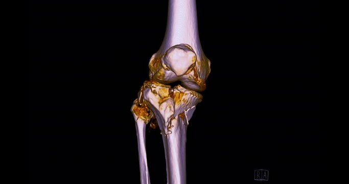 CT Scan of knee joint  3d rendering image  turn around on the screen for diagnosis  fracture tibia ,fibula and femur bone.