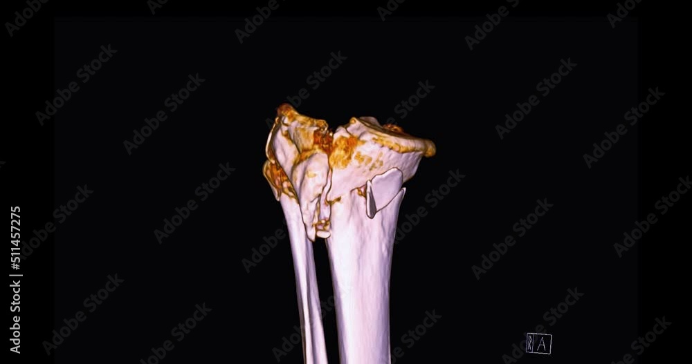 Poster ct scan of knee joint 3d rendering image turn around on the screen for diagnosis fracture tibia ,fib