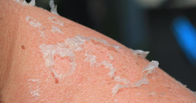 Sunburn - Closeup of Peeling sunburned skin on back and shoulder. Spending time in the sun damages the skin stock video