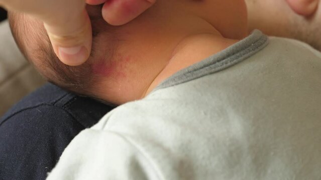stork bite, angel kiss, nevus simplex, birthmark newborn skin, back head, neck