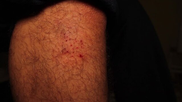 Rubbing a wound (below the knee) in the healing stage, causing bleeding.
At the stage of the scab (wound healing) the person feels itching in the area of ​​injury, allergic.
Educational, Medicine