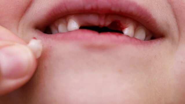 Closeup of unrecognizable baby mouth with no milk tooth, remove from mouth. Children dentistry, dentist industry. Show no primary baby teeth on front. Cropped hand holding tooth near mouth. Treatment
