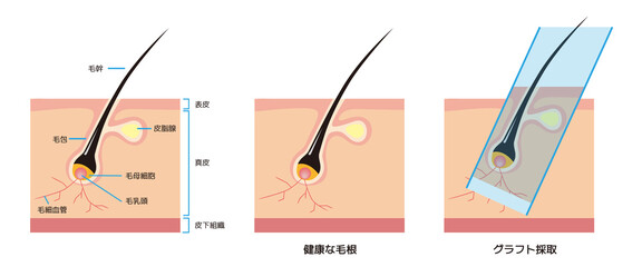 毛根の断面解剖図と薄毛・AGAの自毛植毛