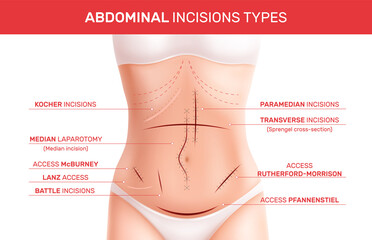 Abdominal Incision Types Infographics
