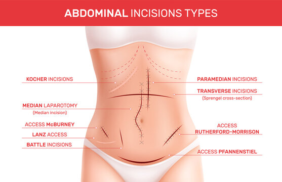 Abdominal Incision Types Infographics