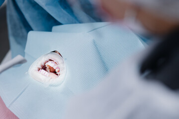 White teeth of the patient before the procedure in the dental office