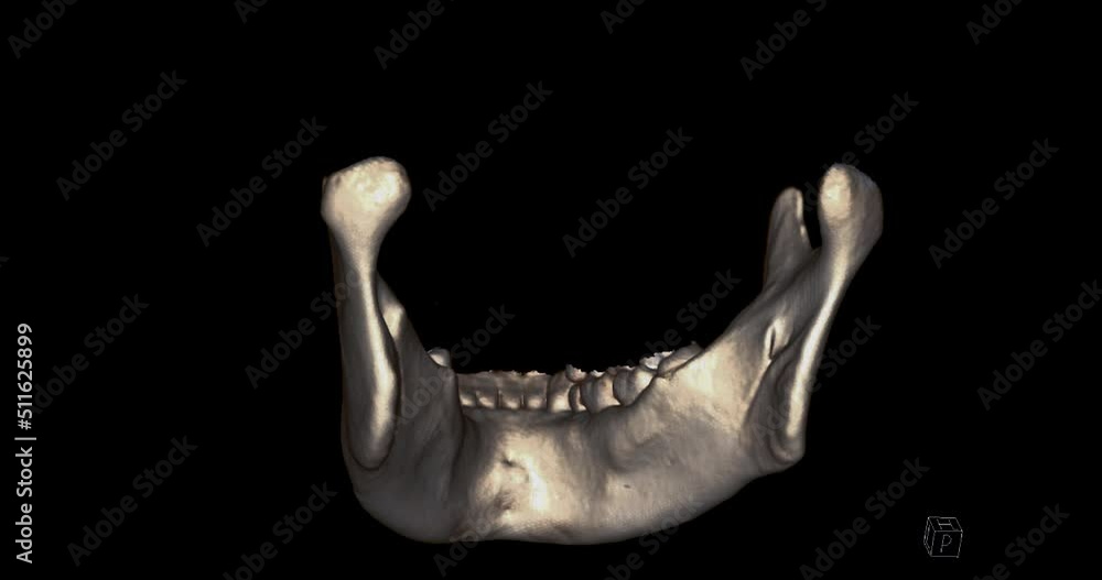 Poster CT SCAN of Mandible bone 3D rendering image .
