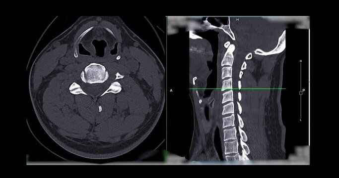 CT SCAN of Cervical Spine ( C-spine ) patient trauma case case   . Medical technology concept.