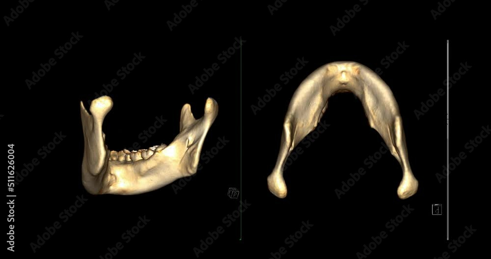 Poster CT SCAN of Mandible bone 3D rendering image .