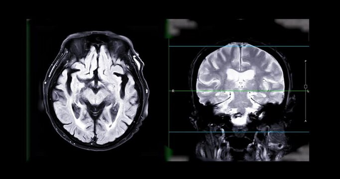 MRI of the brain or Magnetic resonance imaging of the brain for diagnosis brain tumor and stroke diseases. 