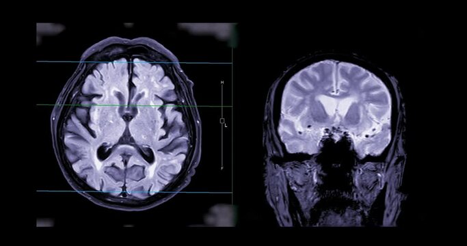 MRI of the brain or Magnetic resonance imaging of the brain for diagnosis brain tumor and stroke diseases. 