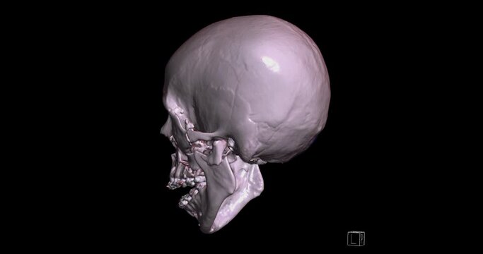 CT Scan of facial bone 3D rendering showng human skull 
 turnaround on the screen .
