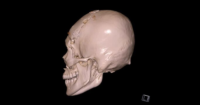 CT Scan of facial bone 3D rendering showng human skull 
 turnaround on the screen .