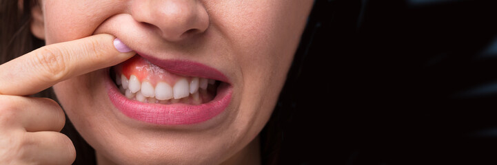 Woman Showing Swelling Of Her Gum