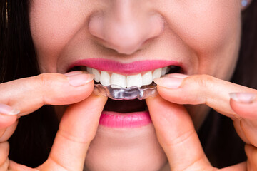 Woman Putting Transparent Aligner In Teeth