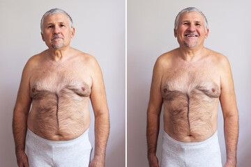 Mature Man Before And After Weight Loss On White Background