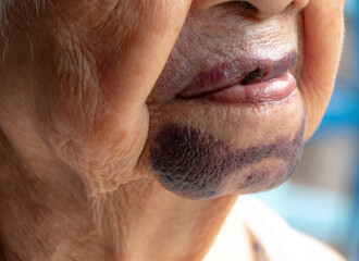 Close up chin senior woman has bruises