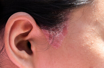 Close up sideburns girl has ringworm fungal lesions