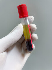 Red test tube non anticoaglant clotted blood.