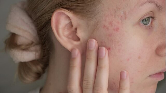 Woman with post acne scars. Skin health. 