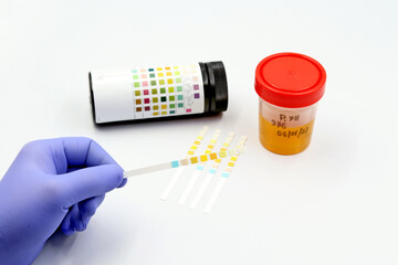 Hand of a scientist or doctor with a blue glove, examining a strip of urine test for the detection...
