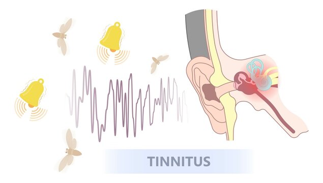 Tinnitus disorder a ringing sound in the ear hearing loss wave level anxiety test assist exam inner exposure problem circulatory nerves hair cell canal Earwax
