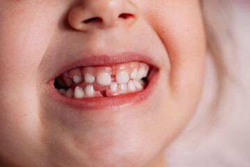 close-up clenched teeth of a five-year-old child showing a recent gum wound from a fallen baby...