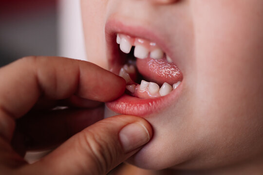 close-up of an open mouth and a mother's hand pulling out the first baby tooth.