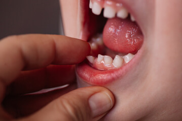 close-up mouth and first straggering temporary tooth of a five-or six-year-old child.