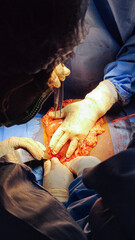 A group of surgeons doing an open abdominal surgery 