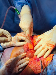 A group of surgeons doing an open abdominal surgery 
