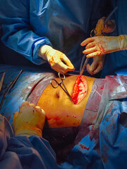 A group of surgeons doing an open abdominal surgery 