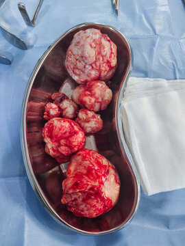 A picture of a fibroid (multiple myoma) surgically removed from the uterus of a patient 