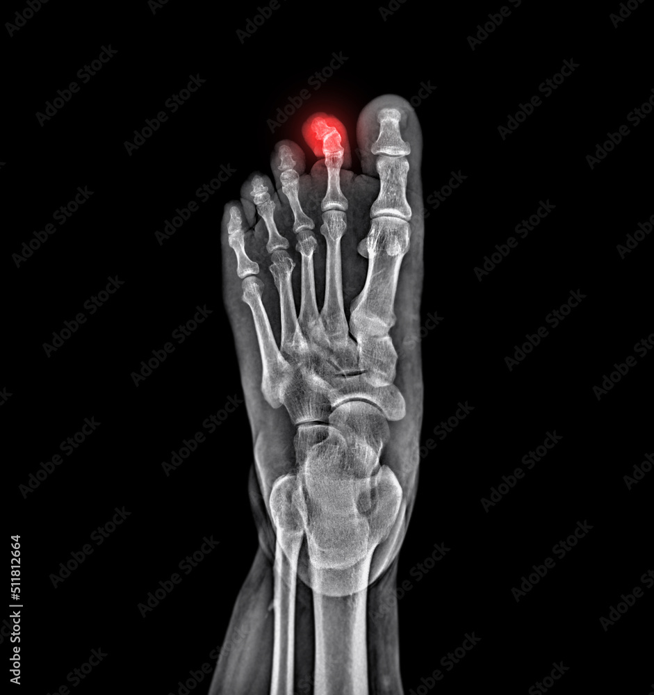 Poster foot x-ray image showing dislocation of toe isolated on black background.